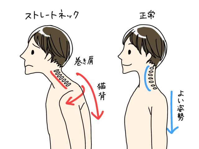 首の角度で頭の重みは3倍以上に？ストレートネックを徹底解説 – ゼロスポ鍼灸・整骨院 平塚