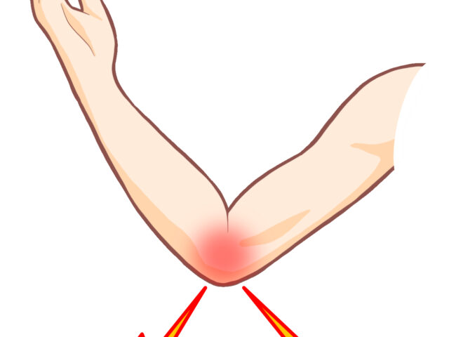 テニス肘・ゴルフ肘は整骨院で根本改善